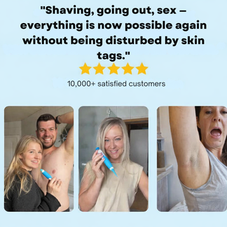 DermaPen™ | Bye Bye Skin Tags