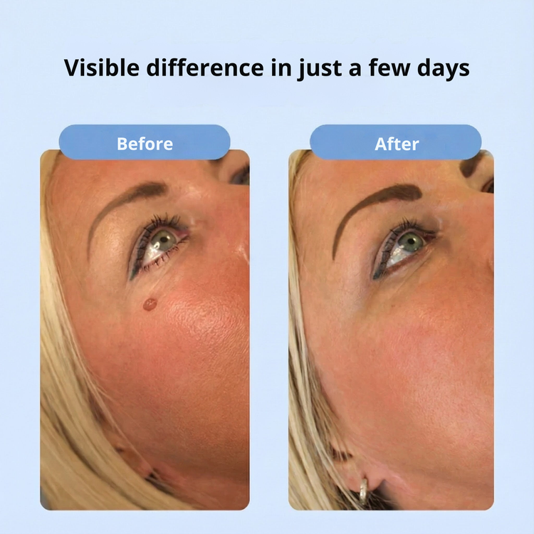 DermaPen™ | Bye Bye Skin Tags
