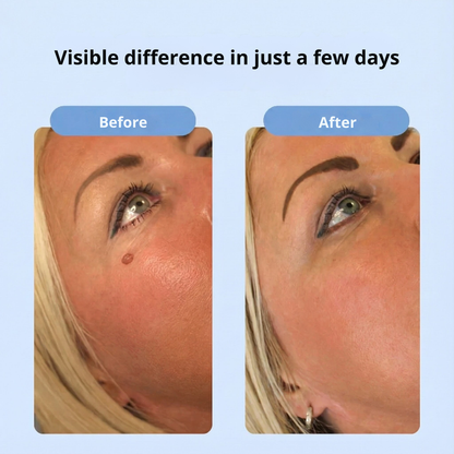 DermaPen™ | Bye Bye Skin Tags